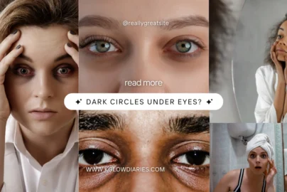 A collage of five images showing different people with visible dark circles or puffiness under their eyes; center text reads "DARK CIRCLES UNDER EYES?" with the website www.kglowdiaries.com.