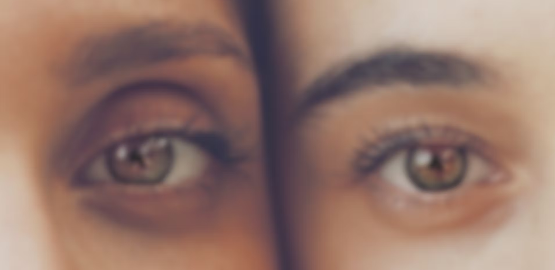 What Causes Dark Circles Under Eyes? Scientific Explanation