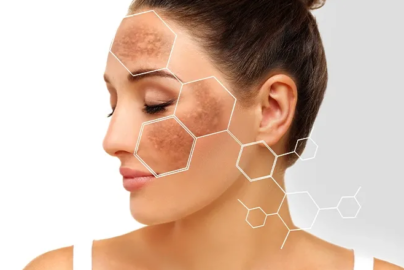 Why Does Hyperpigmentation Happen? Causes Explained