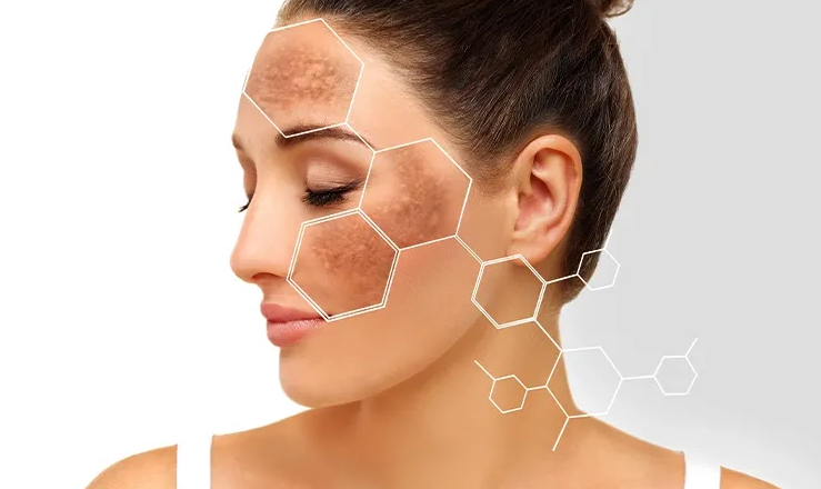 Why Does Hyperpigmentation Happen? Causes Explained